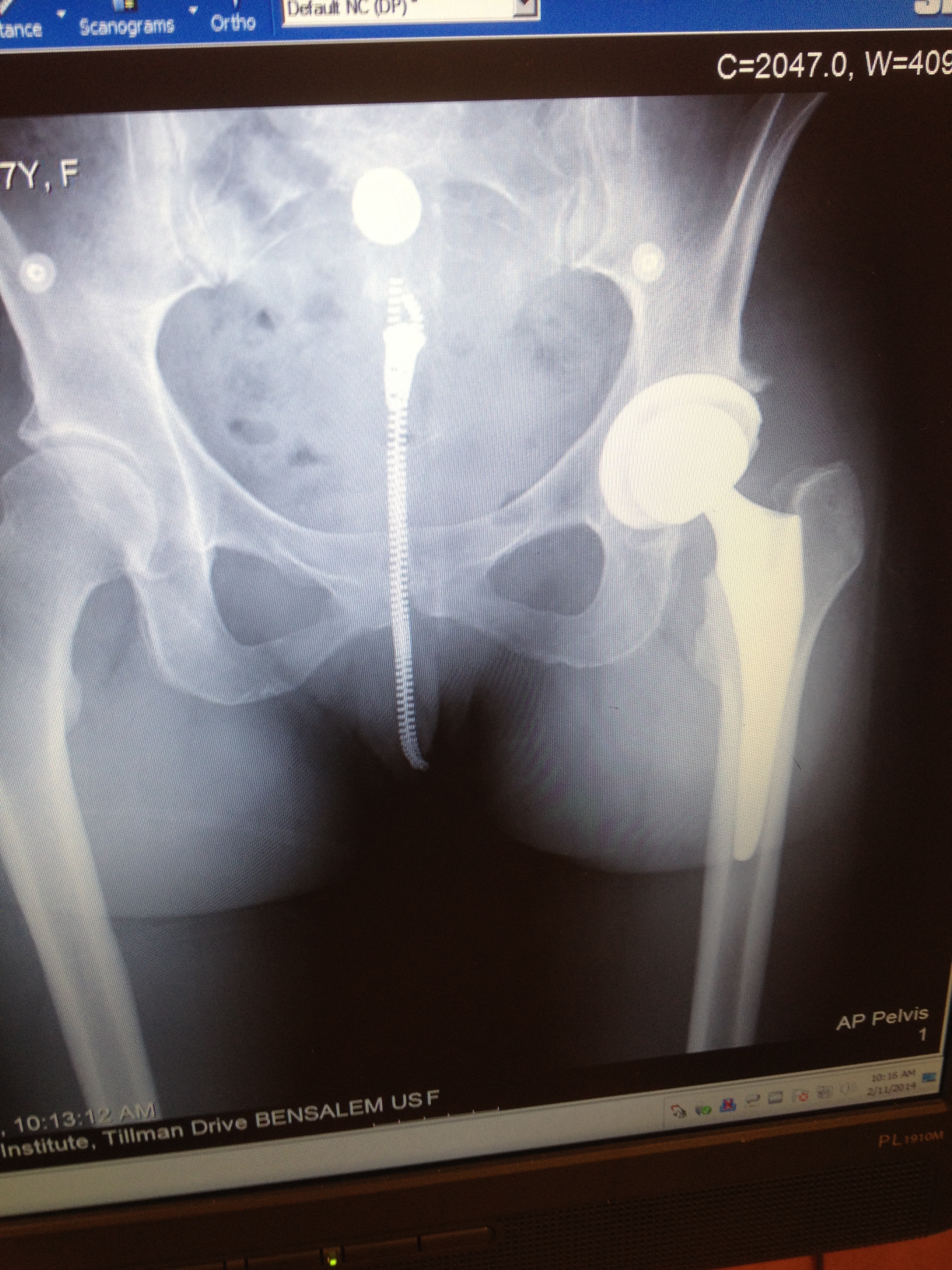 This is my post op X-ray of the hip replacement surgery.  Healing well!